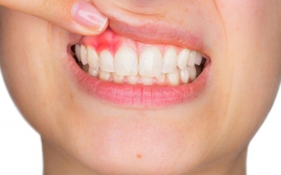 “Thủ phạm” gây viêm lợi và cách phòng ngừa thế nào?