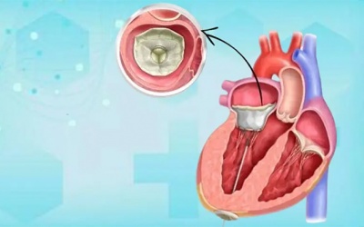 Bệnh hở van tim và tim to có chữa khỏi được không?