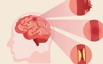 Dấu hiệu tai biến mạch máu não thường bị bỏ qua 
