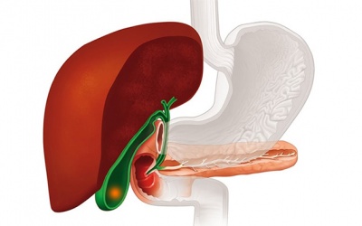 Sỏi mật 25mm dùng TPBVSK Kim Đởm Khang được không?