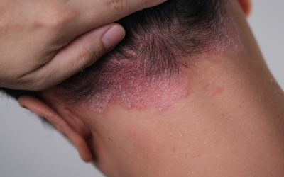 Vảy nến da đầu dễ tái phát, cải thiện ra sao?