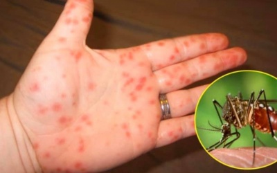 Sốt xuất huyết, tay chân miệng nặng tăng cao, Bộ Y tế cảnh báo khẩn