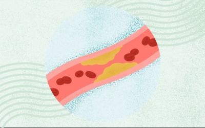 Bạn có thể mắc bệnh mạch vành dù không hề bị đau tức ngực?