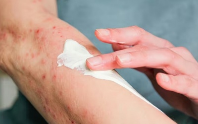 Dấu hiệu thường gặp của bệnh zona