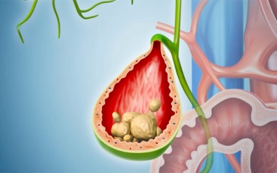 Khi nào sỏi túi mật 17mm trở thành vấn đề đáng lo ngại?