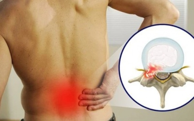 Thói quen hàng ngày khiến bệnh thoát vị đĩa đệm nặng hơn