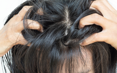 5 yếu tố âm thầm khiến vảy nến da đầu tái phát liên tục