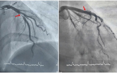 Thanh niên 29 tuổi phát hiện nhồi máu cơ tim cấp khi đi nội soi dạ dày