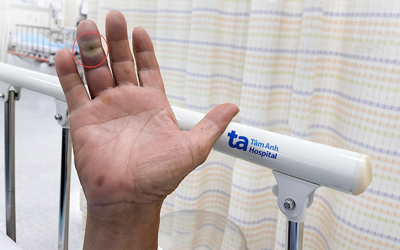 Nguy cơ nhiễm trùng nặng từ vết chó cắn