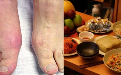 Mẹo để ngăn bệnh gout “ghé thăm” ngày Tết
