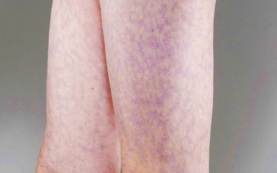 Dấu hiệu lạ trên da có thể cảnh báo vấn đề tim mạch