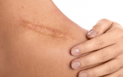 Cùng là vết thương, vì sao mặt ít sẹo hơn cơ thể?