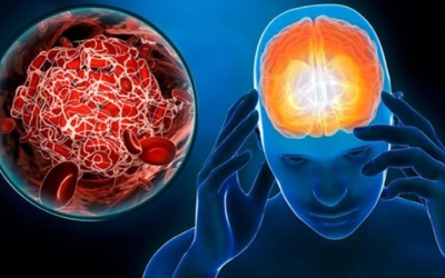 Nguyên nhân tai biến mạch máu não và cách phòng ngừa hiệu quả