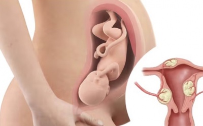 U xơ tử cung có gây khó mang thai không?