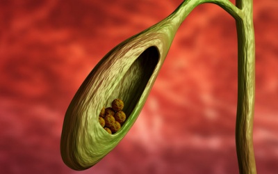 Sỏi túi mật 4,5mm dùng TPBVSK Kim Đởm Khang được không?