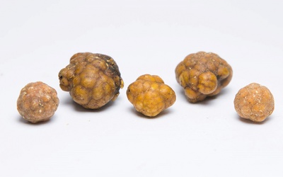 Sỏi mật 39mm nguy hiểm tới thế nào?