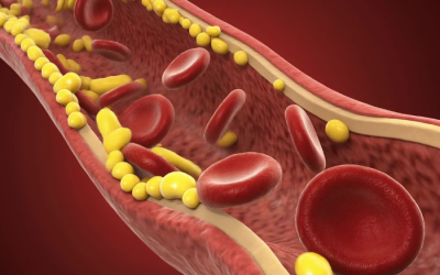 Mới mắc mỡ máu cao cần làm gì để tránh biến chứng nguy hiểm?