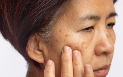 Phân biệt sạm da, tăng sắc tố và nám để bảo vệ da hiệu quả