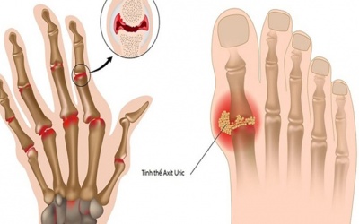 Chế độ ăn uống giúp giảm acid uric