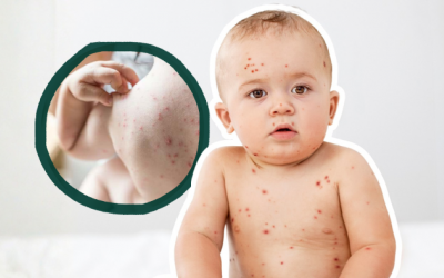 Cách giảm ngứa khi mắc thủy đậu