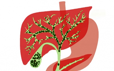 Sỏi gan 7,5mm nên mổ hay dùng cách tẩy sỏi gan 1 ngày?