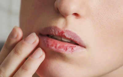 Giải pháp cải thiện tình trạng môi khô, nứt nẻ