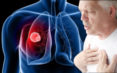 Cách kiểm soát triệu chứng khó thở do u phổi