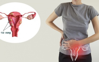 U xơ tử cung có gây hiếm muộn không?