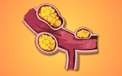 Xơ vữa động mạch: Nguyên nhân, mức độ nguy hiểm và giải pháp hỗ trợ phòng ngừa