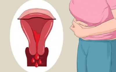 Dấu hiệu u xơ tử cung dưới niêm mạc giúp chị em “bắt” bệnh sớm