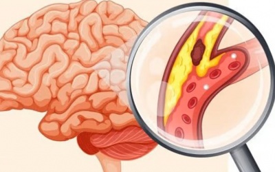 Những ai dễ bị nhồi máu não?