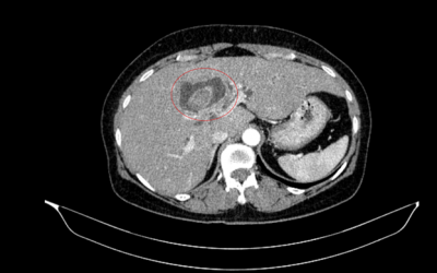 Phát hiện mắc đồng thời 2 bệnh ung thư nguy hiểm từ dấu hiệu vàng da