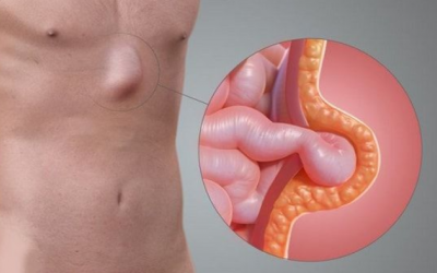 Làm thế nào để tự đánh giá nguy cơ mắc thoát vị?