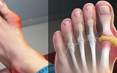 Bệnh gout cấp có chữa khỏi được không?