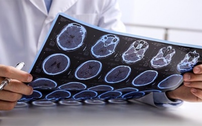 3 yếu tố làm tăng nguy cơ tử vong do bệnh đa xơ cứng