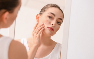 Infographic: Tại sao người trưởng thành vẫn có thể bị mụn?