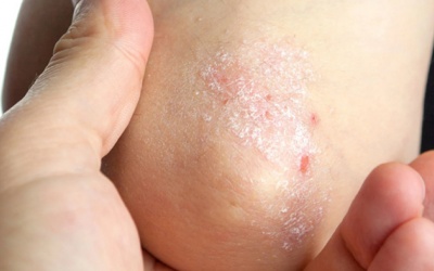 Cây sói rừng - thảo dược hỗ trợ cải thiện bệnh vảy nến hiệu quả