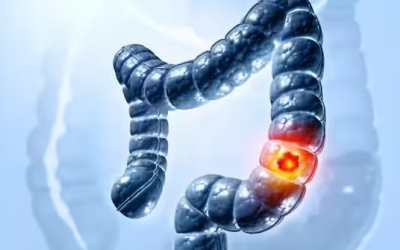 5 dấu hiệu ung thư đại tràng phổ biến dễ bị bỏ qua