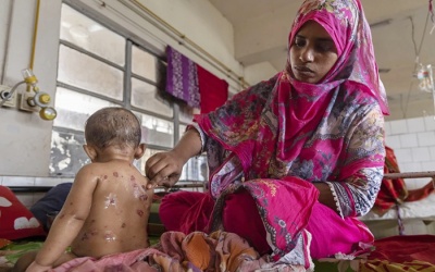 Bangladesh: Gần 100 trẻ em tử vong nghi do dịch sởi bùng phát