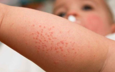 Bệnh sởi và nguy cơ suy giảm miễn dịch