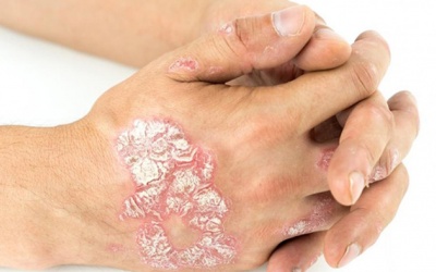 Bị vảy nến thể mảng cần lưu ý những gì?