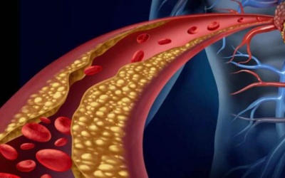 Rối loạn lipid máu có chữa khỏi được không?