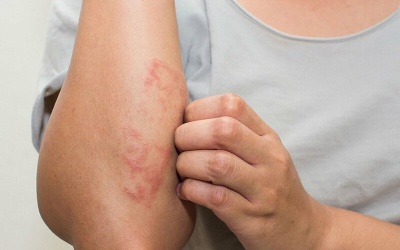 Viêm mao mạch dị ứng ở trẻ em có nguy hiểm không?