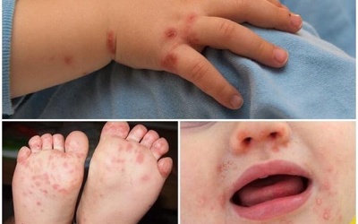 Sốt xuất huyết và tay chân miệng cùng gia tăng mạnh