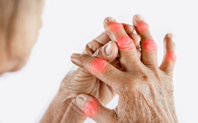 6 bí quyết kiểm soát acid uric, ngăn chặn cơn đau gout cấp