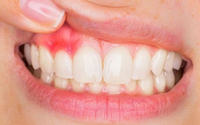 Mách bạn 5 cách cải thiện viêm lợi tại nhà