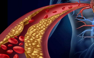 Rối loạn lipid máu: Nhận diện nguy cơ và giải pháp kiểm soát an toàn