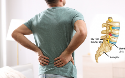 Triệu chứng cảnh báo thoát vị đĩa đệm lưng không nên bỏ qua