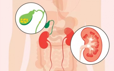 Sỏi mật có gây ra các vấn đề về đường tiết niệu không?