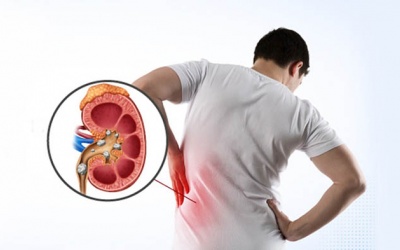 Chế độ ăn uống giúp ngăn sỏi thận tái phát